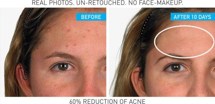 La Roche-Posay Effaclar Dou [+] giúp giảm viêm và kháng khuẩn nhanh chóng